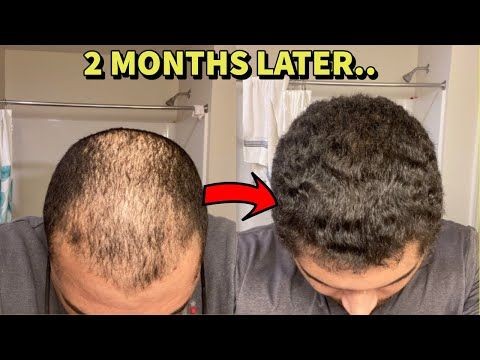 Bald No More: The Revolutionary Remedies for Hair Loss Exposed