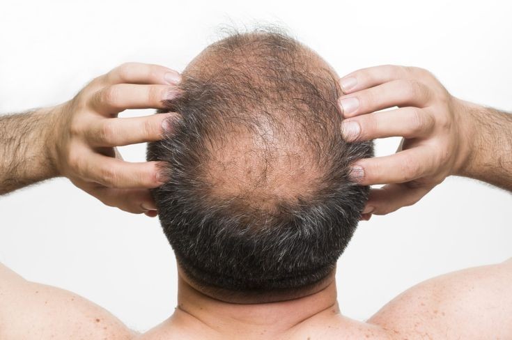 hair loss medications