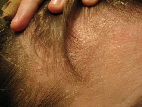 Ways To Stop Hair Thinning